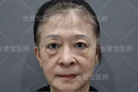 58岁做完眼袋手术变这样，心里很后悔，揭秘3个真相图片