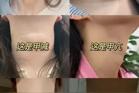 桥本甲状腺炎要注意！2不吃5不做，拒绝终身甲减！图片
