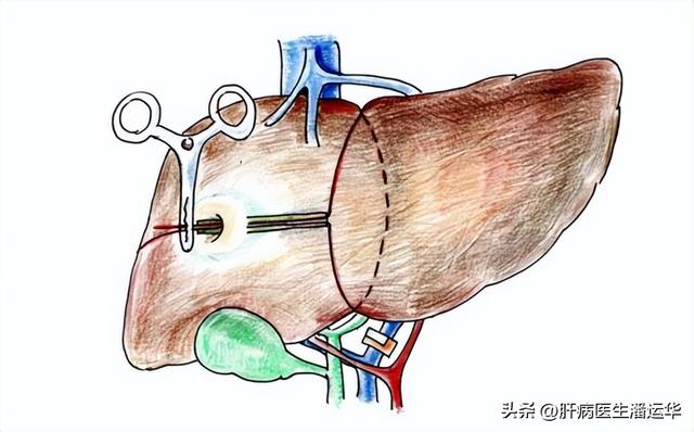得了肝癌究竟能活多久？肝病专家跟你说实话！