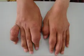 为什么痛风多发生在你脚上？图片