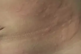 “浑身风团，瘙痒难耐”伴有恶心呕吐，是过敏？图片