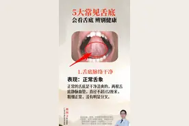 5种常见舌底 健康就看你图片