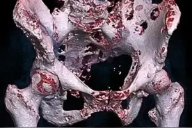 被癌细胞啃咬后的样子，背后承受着多大的痛苦有谁知？图片