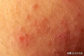 天气热湿疹加重、复发怎么办？图片