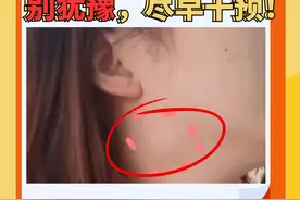 腮腺两公分肿块，质地硬，别犹豫，尽早干预！图片