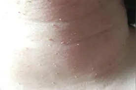 脖子和腋下的"小肉粒"是什么？能直接用手揪掉吗？图片