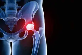 骨科医生告诉你，拍片子X线、CT和核磁如何选，并不是越贵越好！图片