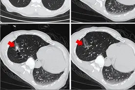 用“针”扎死肺癌肺结节，省中医院治疗肺癌有“神兵利器”图片