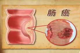 健康研究发现：若是做了肠癌手术，这3物就不要吃了，提前了解图片
