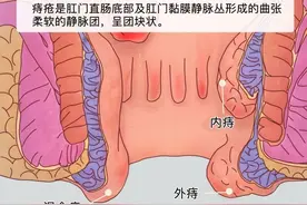 痔疮肉球怎么消除？？？图片