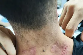 中医二羊：10多年的湿疹愈合，鼻炎也不见了，体质改善图片