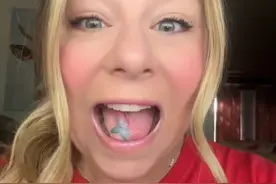 美国女子因病切舌，用文身过的皮肤重建舌头！现在嘴里有颗星星图片