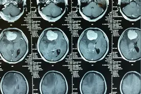 37岁男子头痛、视力减退，一查颅内脑膜瘤——贺晓生教授手术案例图片