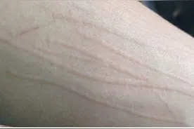 划痕性荨麻疹怎么治疗？图片