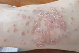 梅毒病是最脏的病？为什么这么说？听医生解说完，一阵头皮发麻！图片