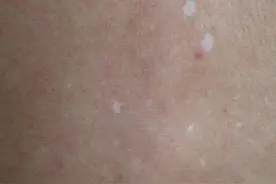 皮肤变白就一定是白癜风？别慌，这 5 种情况了解下！图片