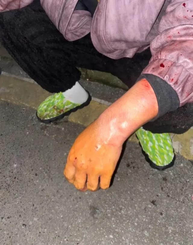 女子小区散步遭大狗咬断手筋，小伙冲下2楼摁住肇事狗，手掌被咬穿，最新情况→