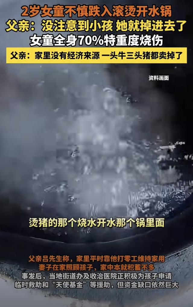 2岁女童跌入开水锅！70%烫伤背后，三秒疏忽一生伤痛