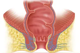 肛瘘诊疗措施图片