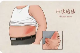 与时间赛跑，带状疱疹治疗要趁早，把握黄金72小时图片