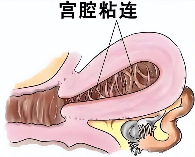25-35岁女性反复人流，小心宫腔粘连，出现6类症状，及时就医