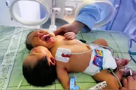 中国首例“双头宝宝”，仅在3个月，单胎变双胎儿，究竟为何？图片