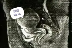 揪心！37岁高龄孕妇检查发现子宫肌瘤，竟有18厘米大图片