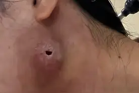 脖子上竟然能长出巨型火疖子？这要是不控制全部要烂完！图片