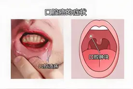 八旬老人罹患口腔癌无法进食，精准介入不开刀！图片