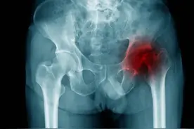 一张方子，专治疗股骨头坏死，活血生骨、补益肝肾，除痹痛！图片