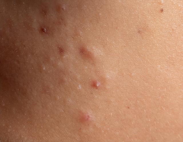 50岁女子脖子长疙瘩以为是脂肪粒，确诊HPV！医生：这些部位注意