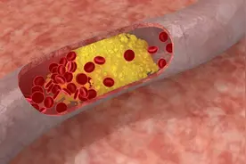 上海交大研究：胆固醇越低，癌症风险越高？4个方法稳控血脂图片
