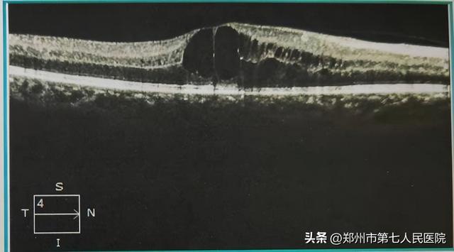 黄斑水肿如何消？专家这里有新招儿
