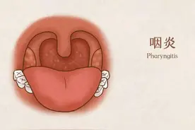 慢性咽炎反复发作，究竟怎么治？一个经典方来帮你图片