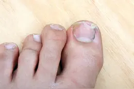 指（趾）甲受伤，严重甲下瘀血，疼痛难忍，医生教您一招图片