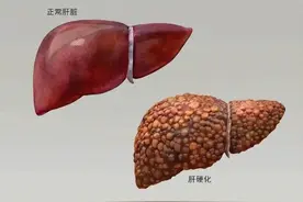 提醒：肝硬化一旦出现5个症状，十有八九癌变了，赶紧检查一下图片