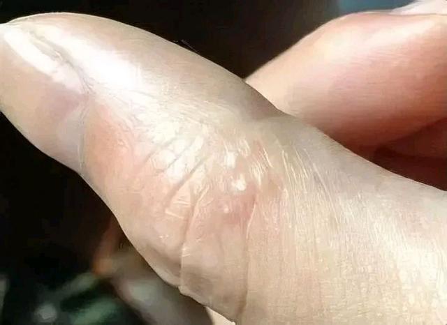 手上长透明小水泡，是上火吗？或许很多人想错了，可能是它在作怪