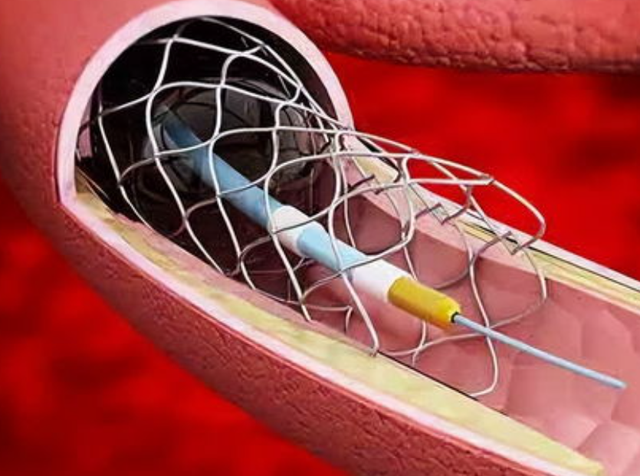 马上停止5类运动，很可能加速血栓形成！等血管堵死就迟了