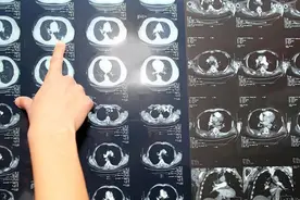 小心后悔！这几种肺结节都是良性的，完全没有必要做手术（下）！图片