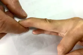 手臂也会"萎缩"？无论男女，当手指出现2类抽筋，一定要及时就医图片