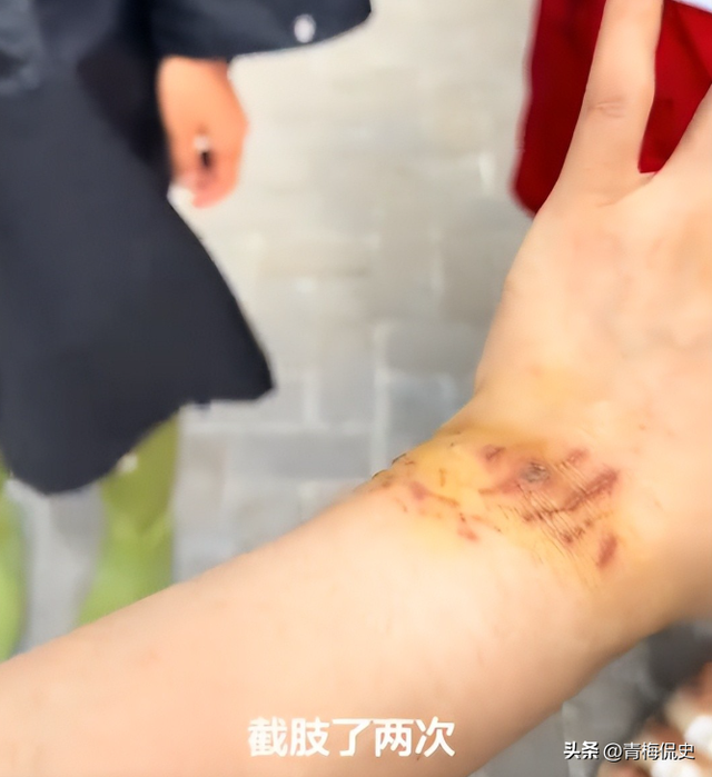 生理期潜水被鲨鱼咬伤后续：女子露面透细节，仍在感染中，已就医