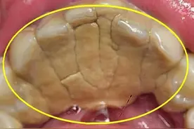 牙结石口臭不用洗牙！每天这样做成本低好操作!图片