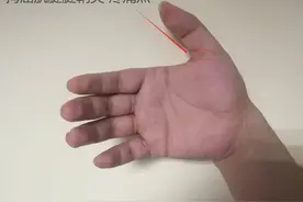 一文认识狭窄性腱鞘炎图片
