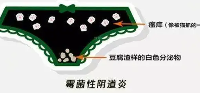 发生霉菌性阴道炎，注意这4点症状，医生告知：治疗做到这6点