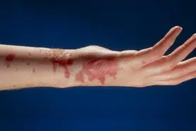 孕期皮肤瘙痒怎么办？专业治疗助你缓解不适，舒适待产！图片