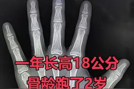 13岁男孩1年长高18公分，不一定是好事，警惕孩子长得太快长不高图片