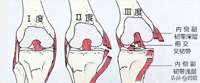 韧带损伤后，3 步加速恢复！轻度 2 周、中度 6 周？自愈时间看这里