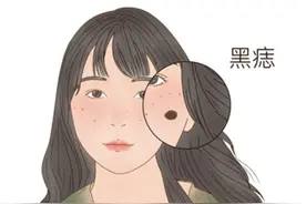 小小年纪长痣了，会癌变吗？能“点”吗？图片