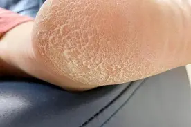 治疗角化型脚气，有这篇就够了！图片