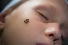 为什么会长胎记？医生：孕期尽量避免3种行为，免得孩子以后自卑图片